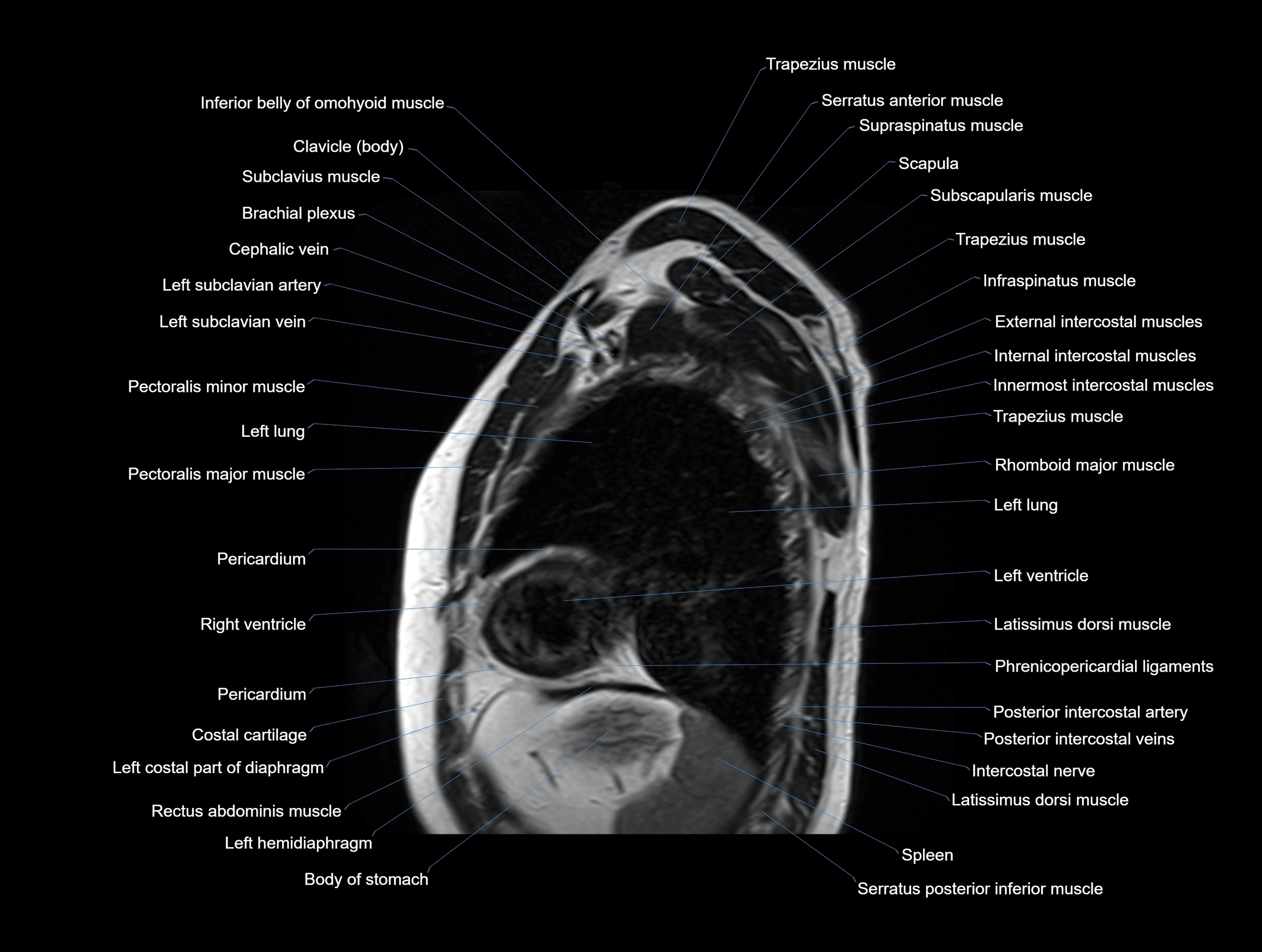 MRI chest (thorax) coronal  cross sectional anatomy 3T radiology  image-img-00001-00030.webp